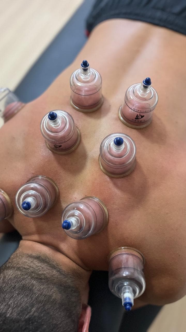Ventosaterapia